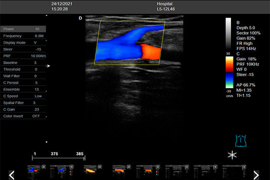 COLOUR-FLOW DUPLEX INVESTIGATION IN SUPERFICIAL VENOUS INSUFFICIENCY OF THE LOWER LIMBS