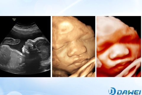Difference between 2D, 3D, 4D & 5D Ultrasound Scanning